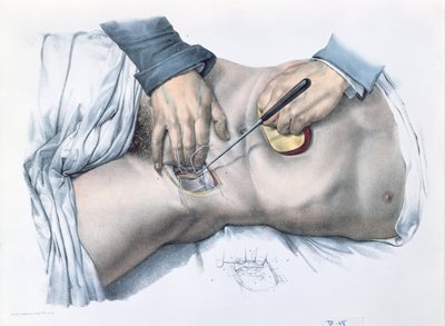 Artéria lekötése, lemez a „Traite Complet de l