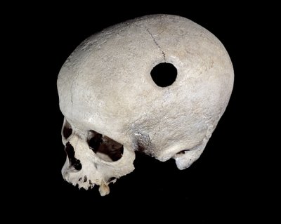 Őskori koponya trepanáció nyomával, Nemzeti Régiségek Múzeuma. alkotó: Prehistoric Prehistoric