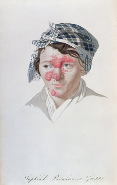 Szifiliás pustulák, báró Jean Louis Alibert (1768-1837) könyvéből, 1838 alkotó: Salvadore Tresca