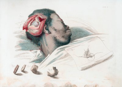 A koponya sebének képe trephinálás és az összetört csontdarab eltávolítása után a bal alsó sarokban, 1821 alkotó: Thomas Landseer