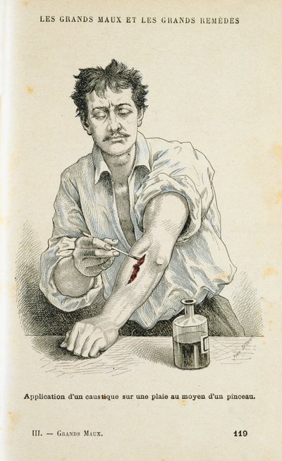 Sebfestés antiszeptikus oldattal, c1890 alkotó: Unbekannt