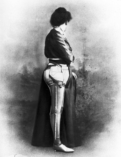 Prothesen Frau mit künstlichem Bein von Unbekannt