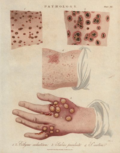 Bőrfekély, gennyes rüh, és rüh okozta scabiei sarcoptic atka - John Pass litográfiája, megjelent John Wilkes "Encyclopedia Londinensis" című könyvében, J.Adlard kiadás, London. alkotó: Unbekannter Künstler
