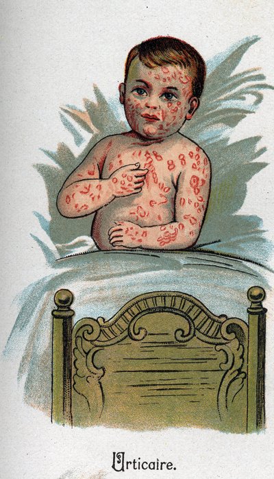 Gyermekbetegségek: csalánkiütés. F.E. Bilz „Az új természetgyógyászat” című könyvében. alkotó: Unknown artist