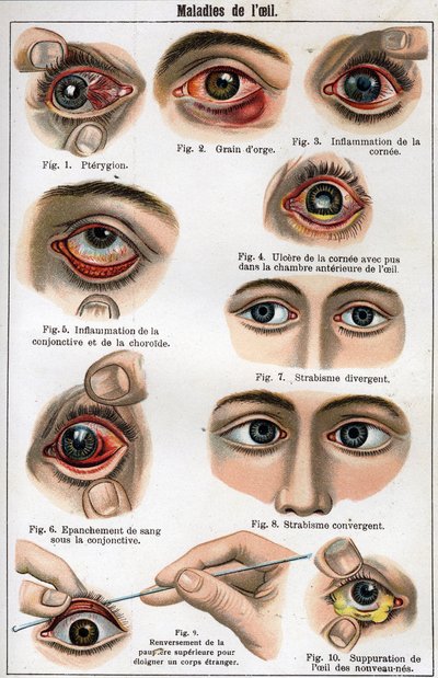 A szem betegségei. F.E. Bilz „Az új természetes gyógymód”. alkotó: Unknown artist