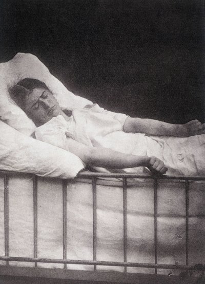 Hystero Epilepsia – Tetanizmus támadás a „Salpétrière fényképes ikonográfiájában: Mr. Charcot szolgálata” Paul Regnard és Bourneville alkotó: Unknown artist