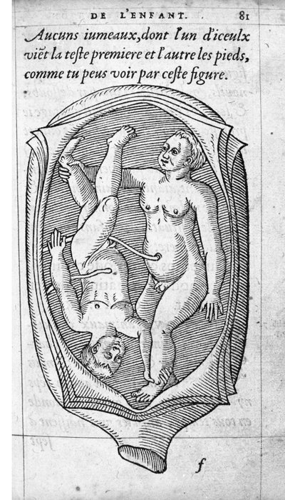 A magzat helyzete a méhben a terhesség alatt. Ambroise Pare francia orvos és sebész (1509-1590) „De la Generation des enfants” című metszete XVI. alkotó: Unknown artist