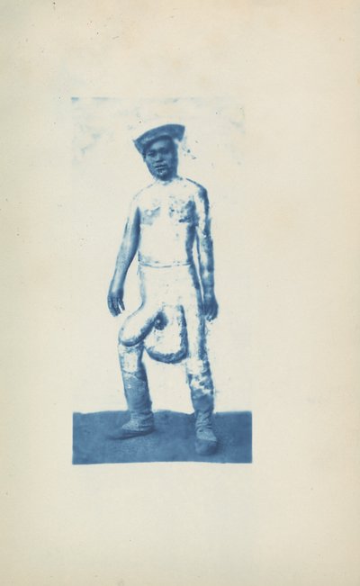 Elefantiázis,c. 1870-es évek (fotó) alkotó: Unknown photographer