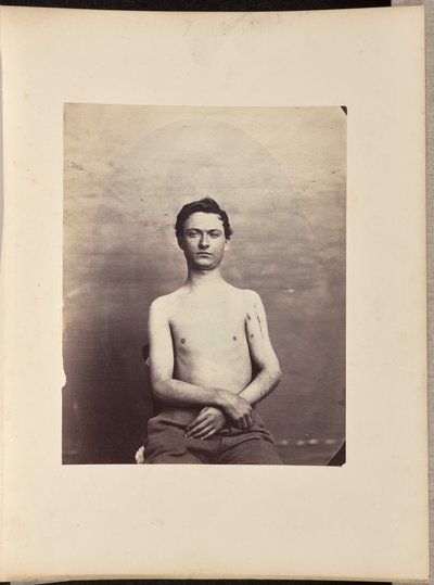 Helyreállítás a bal humerusz fejének eltávolítása után lőtt törés esetén alkotó: William H. Bell