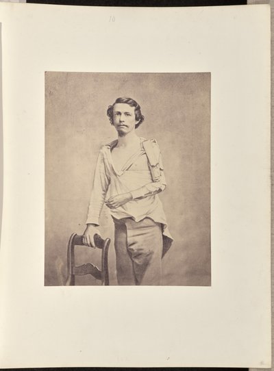 A bal oldali humerusz fejének sikeres kimetszése, majd a humerusz és a radius és az ulna felső végtagjainak nekrózisa és másodlagos kimetszése. alkotó: William H. Bell
