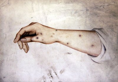 Egy alkar vizsgálata bőrbetegséggel, 1850 körül (akvarell papíron) alkotó: William Lover