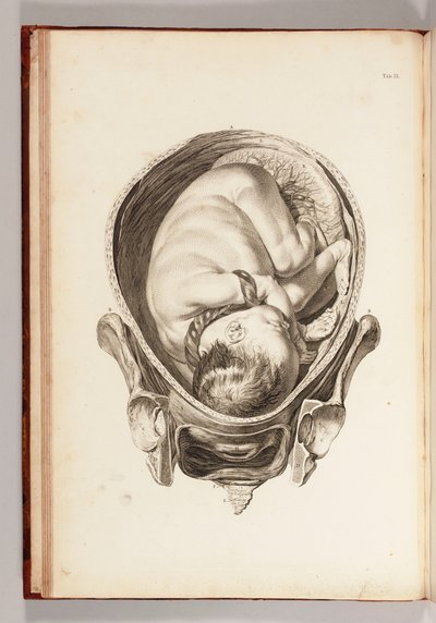 Egy gyermek vésése az anyaméhben az "Anatómiai táblázatok készletéből, magyarázatokkal és kivonattal, a szülésznői gyakorlatról", 1754 alkotó: William Smellie