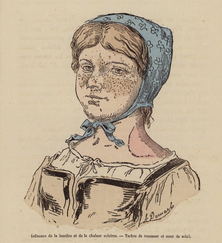 Nő szeplős és a túlzott napozás okozta leégéssel (színes metszet) alkotó: (after) French School