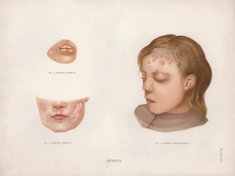 Bőrbetegségek: herpesz (színes litho) alkotó: English School
