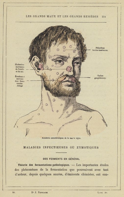 Az akut takony jellegzetes ütései (színes litho) alkotó: French School