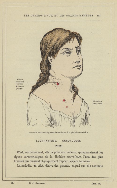 A scrofulosis jellegzetes balesetei a másodlagos időszakban (színes litho) alkotó: French School
