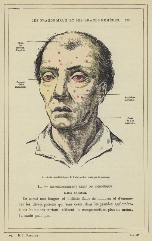 A lassú higanymérgezés jellegzetes balesetei (színes litho) alkotó: French School