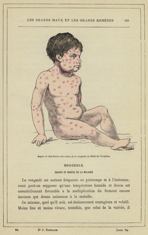 A kanyarófoltok megjelenése és eloszlása ​​a kitörés kezdetén (színes litho) alkotó: French School