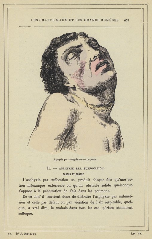 Fulladás fojtással, Akasztott ember (színes litho) alkotó: French School