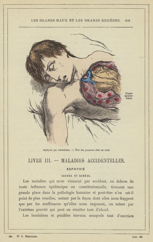 Fulladás vízbe fulladással, Tüdőállapot a fuldokló személynél (színes litho) alkotó: French School