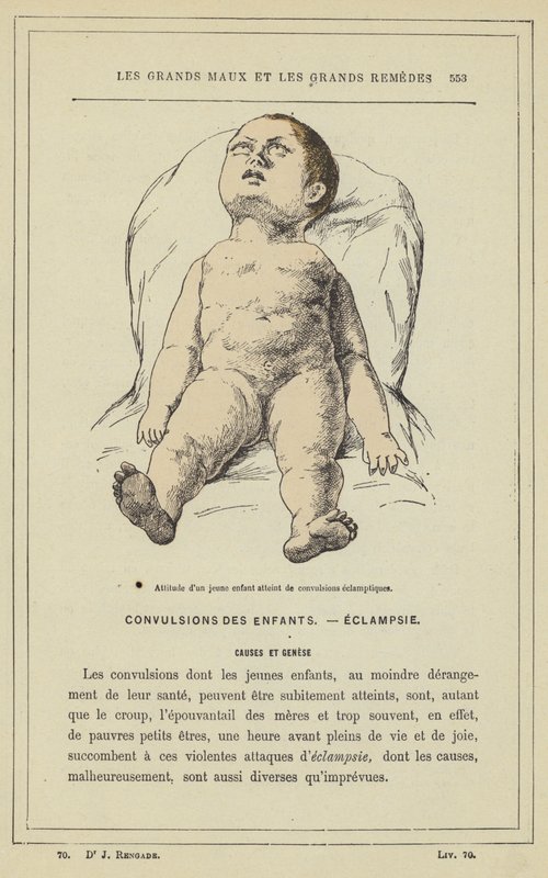 Egy kisgyermek hozzáállása eklampsziás görcsökben (színes litho) alkotó: French School
