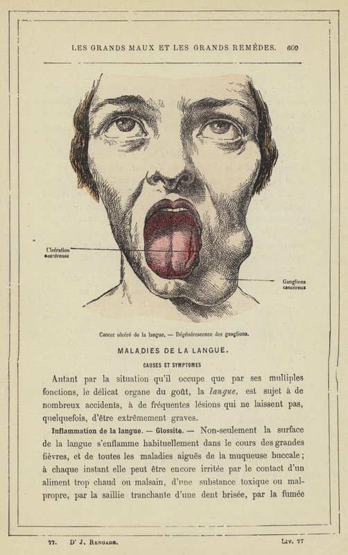 Nyelvfekély rák, nyirokcsomó-degeneráció (színes litho) alkotó: French School