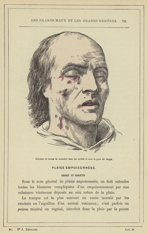 Légylárvák kikelése az üregekben és az arc bőre alatt (színes litho) alkotó: French School