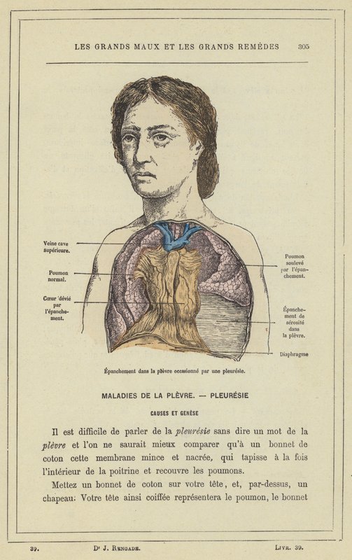 Mellhártyagyulladás által okozott effúzió a mellhártyában (színes litho) alkotó: French School