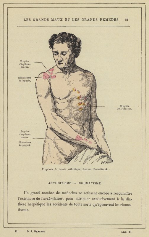 Arthritises jellegű kitörések reumás betegeknél (színes litho) alkotó: French School