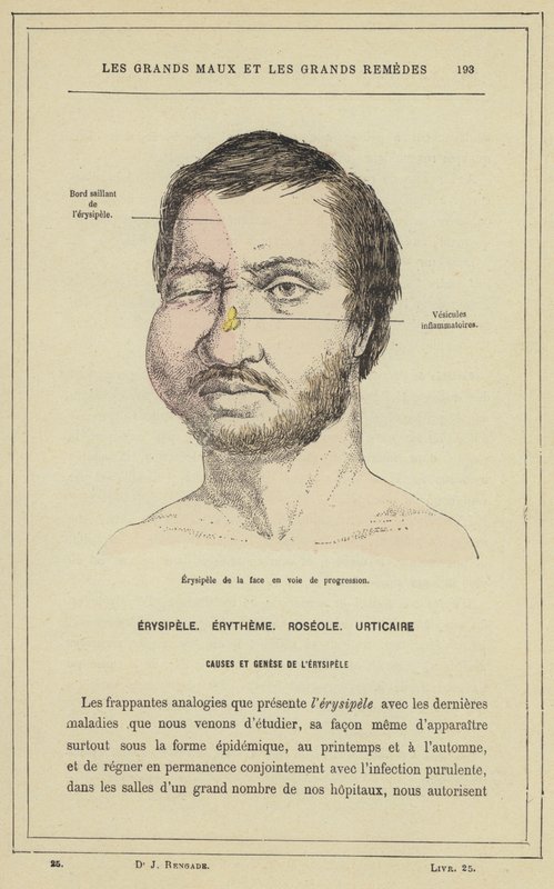 Progresszív erysipela arcra (színes litho) alkotó: French School