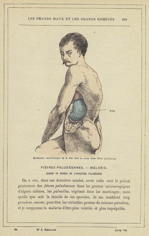 A lép jellegzetes duzzanata maláriás láz során (színes litho) alkotó: French School