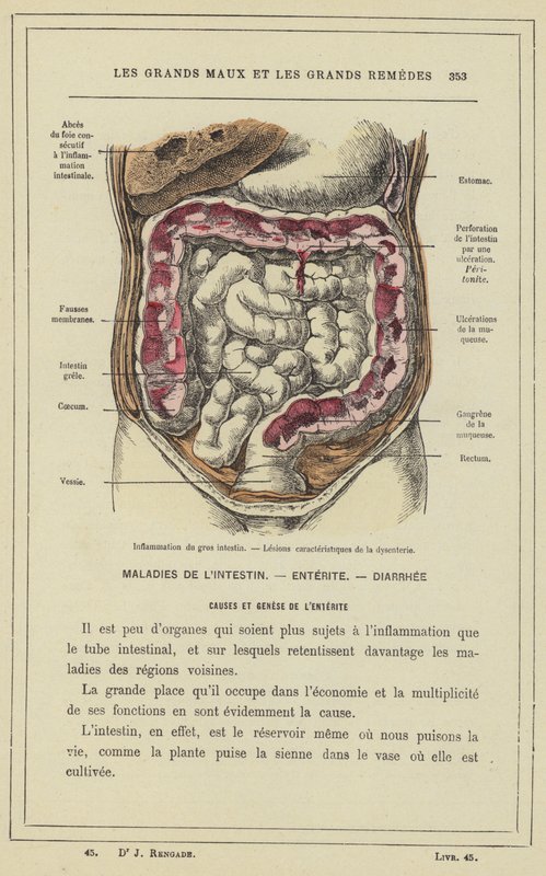 Vastagbél gyulladás, vérhasra jellemző elváltozások (színes litho) alkotó: French School