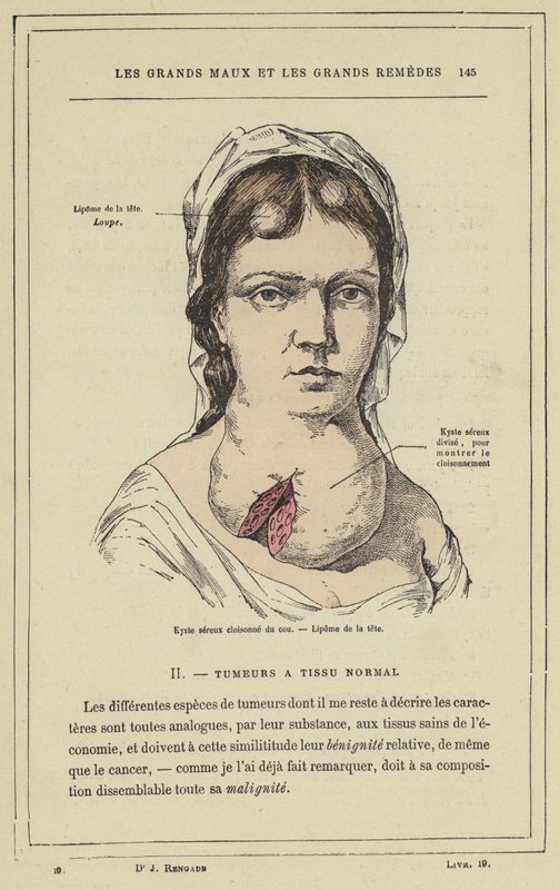 Cloisonne savós ciszta a nyakon, lipoma a fejen (színes litho) alkotó: French School