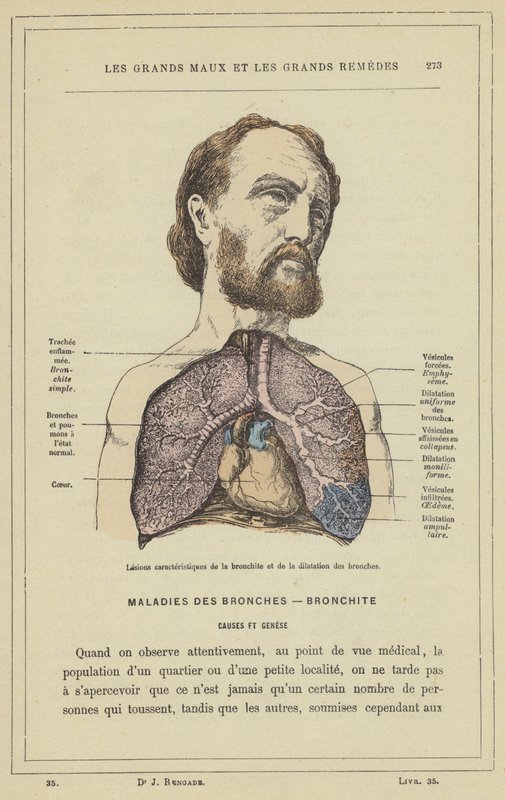 Hörghurutra és hörgőtágulatra jellemző elváltozások (színes litho) alkotó: French School