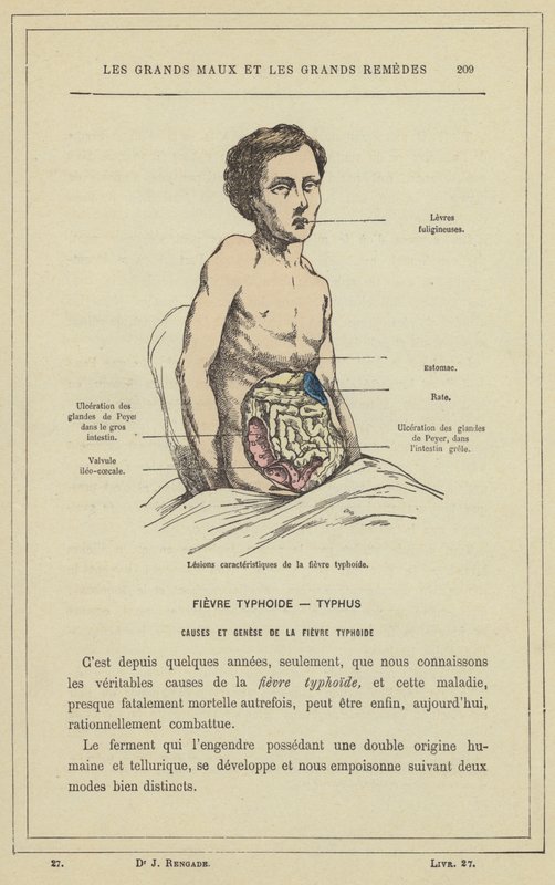 A tífusz jellegzetes elváltozásai (színes litho) alkotó: French School