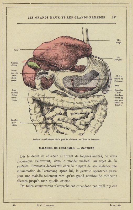 A fekélyes gasztritisz jellegzetes elváltozásai, gyomorfekély (színes litho) alkotó: French School