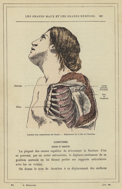A váll szubkorakoid diszlokációja, A humerus fejének elmozdulása (színes litho) alkotó: French School