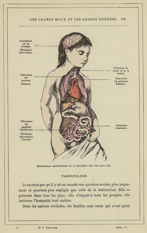 A tuberkulózis jellegzetes megnyilvánulásai egy fiatal lányban (színes litho) alkotó: French School
