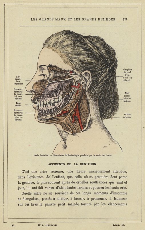 Fogidegek, A fogszuvasodás által okozott odontalgia mechanizmusa (színes litho) alkotó: French School