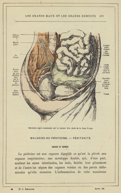Heveny hashártyagyulladás, amelyet az iliac fossa tályog szakadása okoz (színes litho) alkotó: French School
