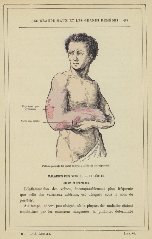 A kar vénáinak mély phlebitise a gennyedés időszakában (színes litho) alkotó: French School