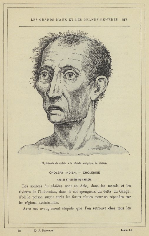 A beteg fiziognómiája a kolera fulladásos időszakában (színes litho) alkotó: French School