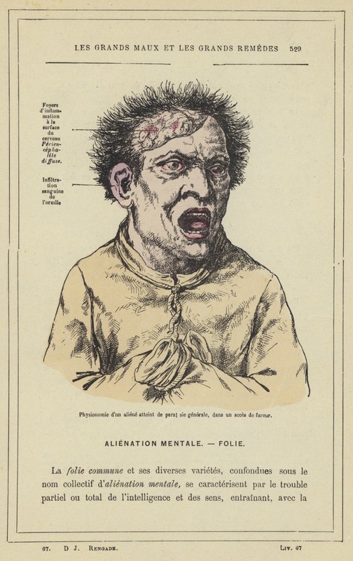 A paral sie generale által érintett idegen fiziognómiája dührohamban (színes litho) alkotó: French School