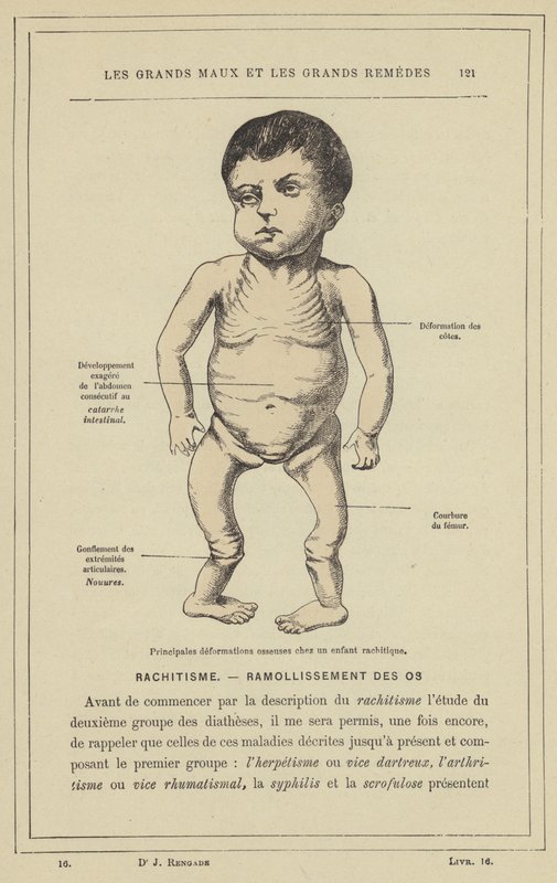 Fő csontdeformációk angolkóros gyermeknél (színes litho) alkotó: French School