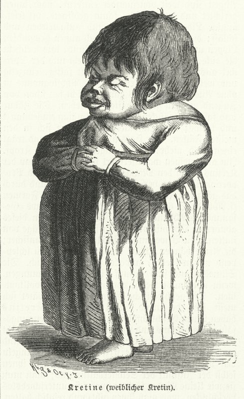 Kretén, veleszületett jódhiány-szindómában szenvedő nő (metszet) alkotó: German School