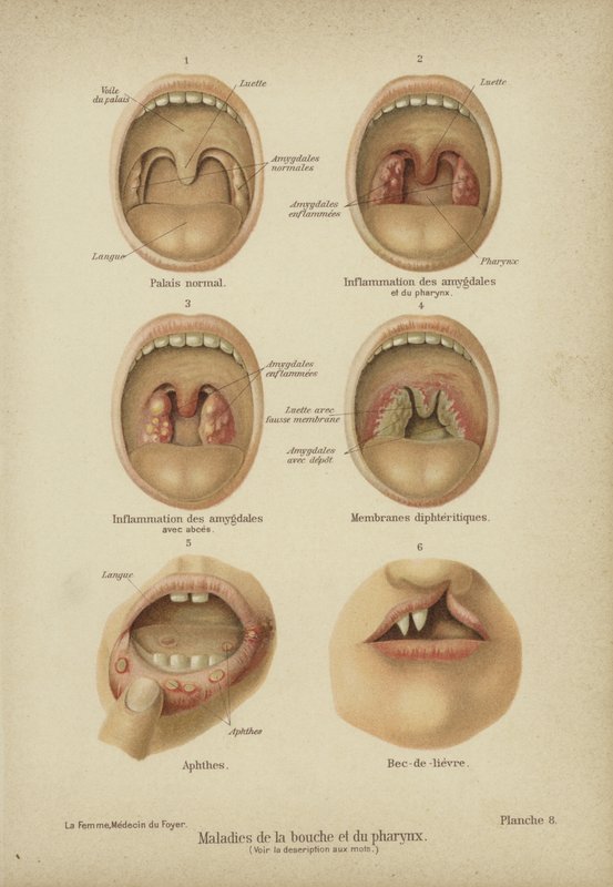 A száj és a torok betegségei és rendellenességei (színes litho) alkotó: German School