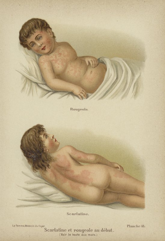 A kanyaró és a skarlát korai tünetei (színes litho) alkotó: German School