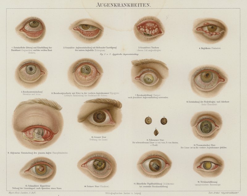 Szembetegségek (színes litho) alkotó: German School