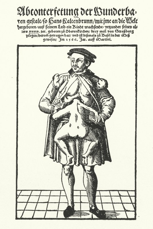 Hans Kaltenbrunn és fejletlen, összenőtt ikertestvére (metszet) alkotó: German School