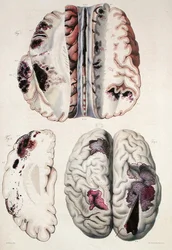 Kapilláris apoplexia, Jean Cruveilhier (1791-1874) „Anatomie Pathologique du Corps Humain” című művéből, 1828-42 (színes metszet)